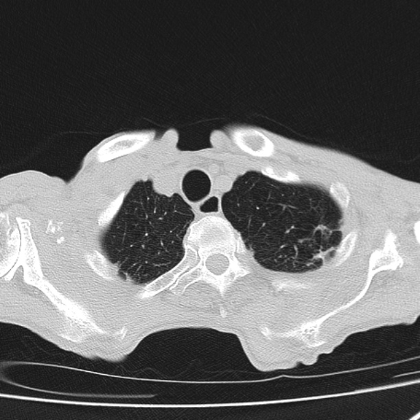 Brain metastases from lung cancer (Radiopaedia 27849-28093 Axial lung window 8).jpg