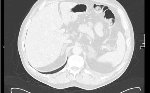 Brain metastases from squamocellular lung cancer (Radiopaedia 56515-63219 Axial lung window 62).jpg