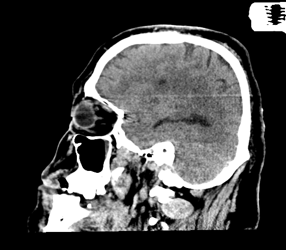 Brainstem hemorrhage (Radiopaedia 81294-94976 C 17).jpg