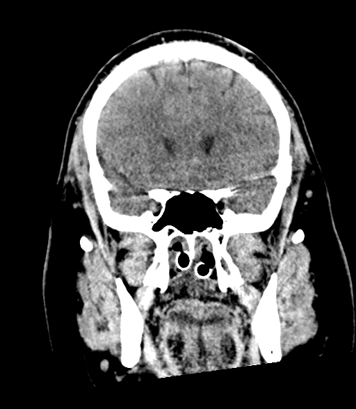 Brainstem hemorrhage (Radiopaedia 81294-94976 Coronal non-contrast 23).jpg