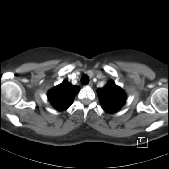 File:Breast metastases from renal cell cancer (Radiopaedia 79220-92225 A 12).jpg