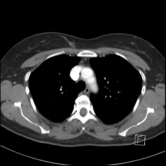 File:Breast metastases from renal cell cancer (Radiopaedia 79220-92225 A 28).jpg
