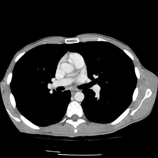 File:Bronchial carcinoid tumor causing right lower lobe collapse (Radiopaedia 83495-98594 A 23).jpg