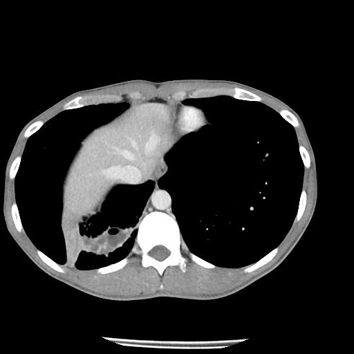 Bronchial carcinoid tumor causing right lower lobe collapse (Radiopaedia 83495-98594 A 44).jpg