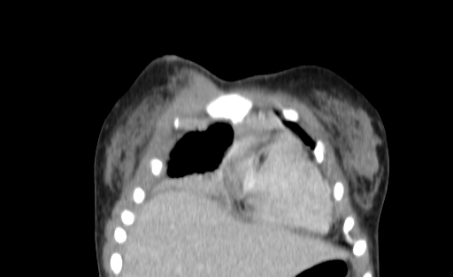 Bronchial mucoepidermoid carcinoma (Radiopaedia 57023-63895 Coronal 7).jpg