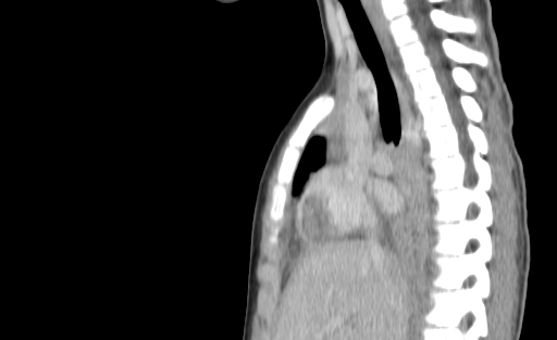 Bronchial mucoepidermoid carcinoma (Radiopaedia 57023-63895 Sagittal 101).jpg