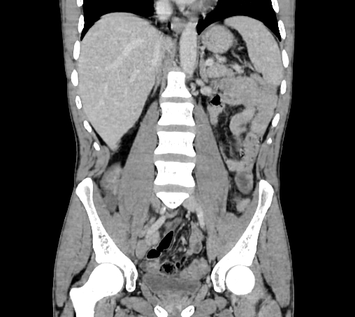 Bronchiectasis in Crohn disease (Radiopaedia 60311-67977 C 44).jpg