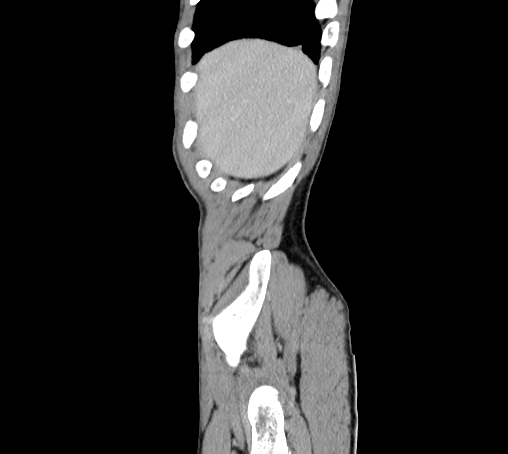 Bronchiectasis in Crohn disease (Radiopaedia 60311-67977 D 4).jpg