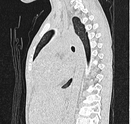 Bronchiolitis obliterans (Radiopaedia 71538-81897 Sagittal lung window 39).jpg