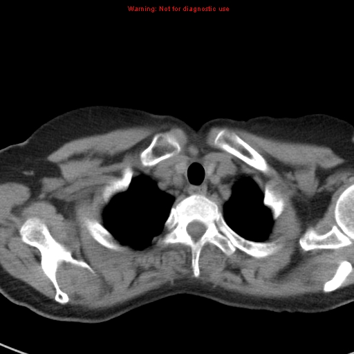File:Bronchoalveolar carcinoma (BAC) (Radiopaedia 13436-13392 Axial non-contrast 5).jpg