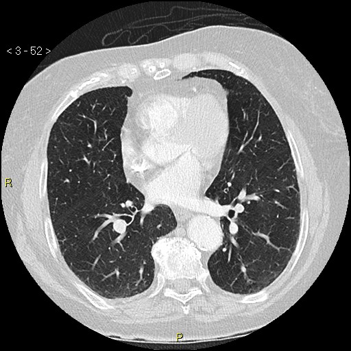 Bronchogenic carcinoma as an incidental finding (Radiopaedia 16453-16130 Axial lung window 52).jpg