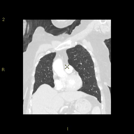 File:Bronchogenic carcinoma as an incidental finding (Radiopaedia 16453-16130 Coronal lung window 20).jpg