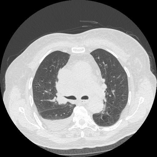 Bronchogenic carcinoma with metastatic lymphadenopathy (Radiopaedia 37671-39569 Axial lung window 23).jpg