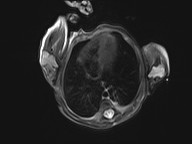 File:Bronchogenic cyst (Radiopaedia 27207-27380 Axial STIR 1).jpg