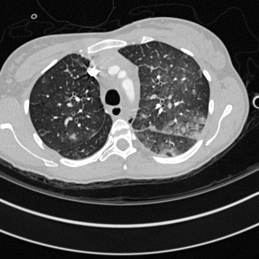 Bronchogenic cyst (Radiopaedia 77801-90071 Axial lung window 14).jpg