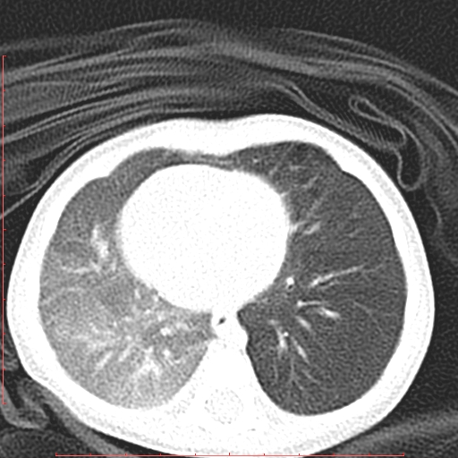 Bronchogenic cyst (Radiopaedia 78599-91409 Axial lung window 95).jpg