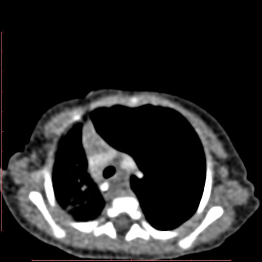 Bronchogenic cyst (Radiopaedia 78599-91409 B 70).jpg