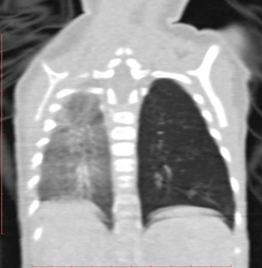 Bronchogenic cyst (Radiopaedia 78599-91409 Coronal lung window 170).jpg