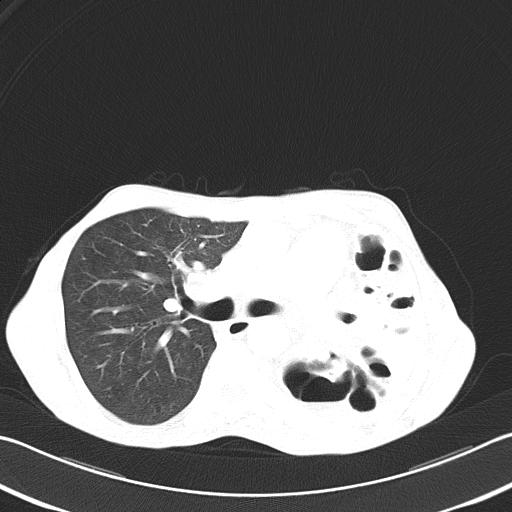 File:Bronchopleural fistula secondary to tuberculosis (Radiopaedia 20415-20322 Axial lung window 25).jpg