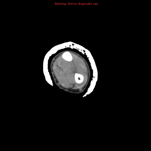 File:Brown tumor (Radiopaedia 12460-12694 Axial non-contrast 73).jpg