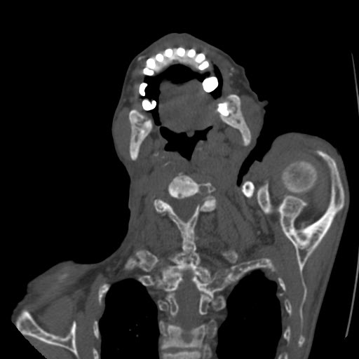 File:Brown tumor with secondary hyperparathyroidism (Radiopaedia 23591-23705 C 20).jpg