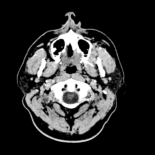 Buccal fat pad arteriovenous malformation (Radiopaedia 70936-81142 Axial non-contrast 29).jpg