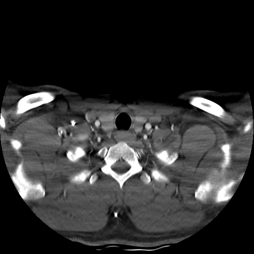 Buccal fat pad arteriovenous malformation (Radiopaedia 70936-81144 A 92).jpg