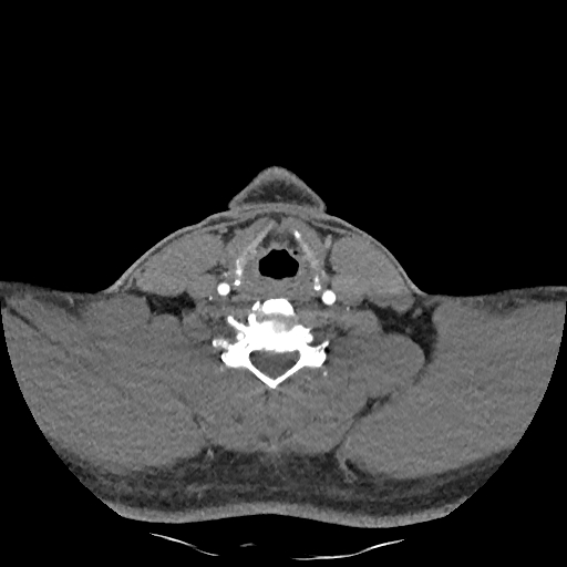 Buccal fat pad arteriovenous malformation (Radiopaedia 70936-81144 D 104).jpg