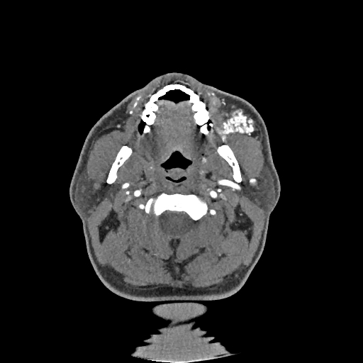 Buccal fat pad arteriovenous malformation (Radiopaedia 70936-81144 D 194).jpg