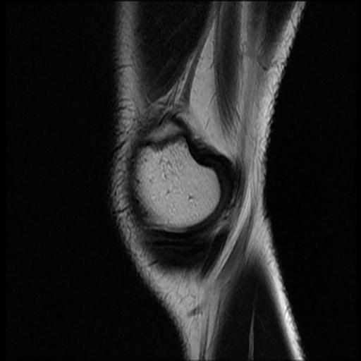 File:Bucket handle tear - lateral meniscus (Radiopaedia 72124-82634 Sagittal T2 15).jpg