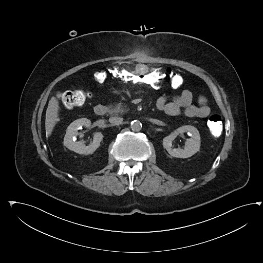 Buried bumper syndrome - gastrostomy tube (Radiopaedia 63843-72577 Axial Inject 40).jpg