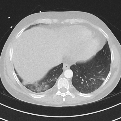 Burkitt lymphoma (Radiopaedia 34686-36121 Axial lung window 38).png
