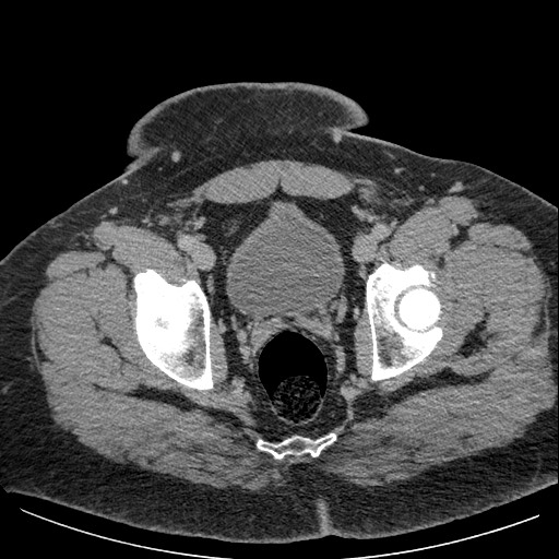 Burned-out testicular seminoma - retroperitoneal nodal metastases (Radiopaedia 62872-71245 A 66).jpg