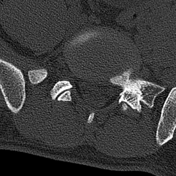 Burst fracture (Radiopaedia 53373-59357 Axial bone window 65).jpg