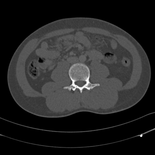 Burst fracture with cauda equina syndrome (Radiopaedia 25701-25867 Axial bone window 96).jpg