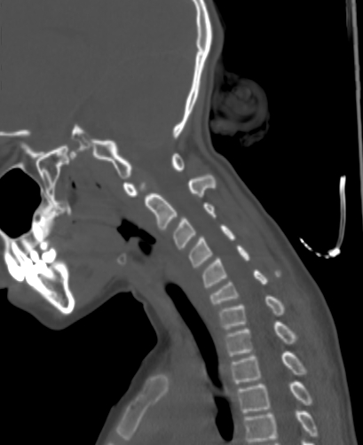 Butterfly vertebra (Radiopaedia 77903-90209 Sagittal bone window 59).jpg