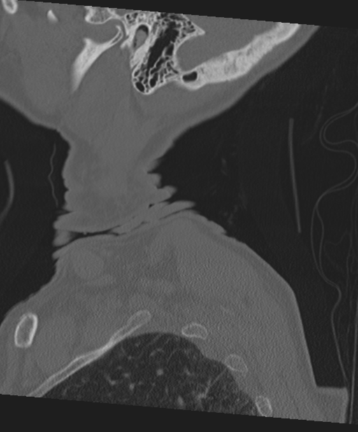 C2 fracture with vertebral artery dissection (Radiopaedia 37378-39199 Sagittal bone window 75).png