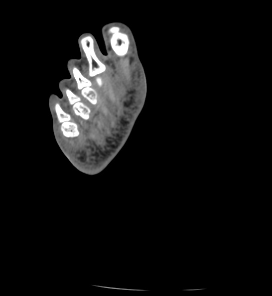 Calcaneal fracture - Sanders type 3ac (Radiopaedia 82491-96862 C 176).jpg