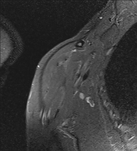 File:Calcific tendinitis of the infraspinatus tendon (Radiopaedia 87256-103537 Coronal PD fat sat 3).jpg