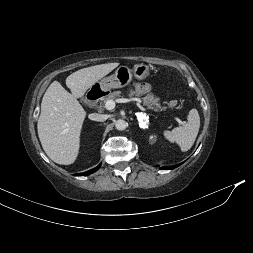 Calcified adrenal glands and Spigelian hernia (Radiopaedia 49741-54988 A 63).jpg