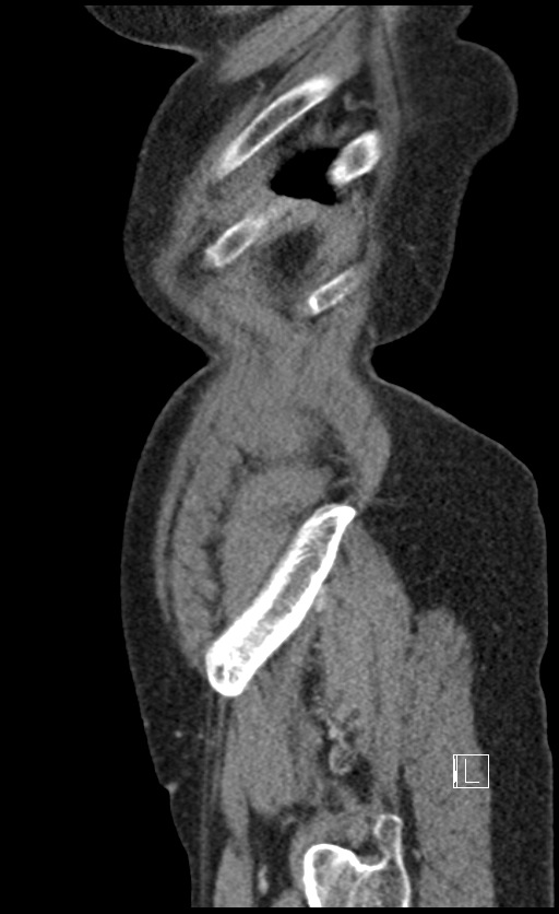 Calcified adrenal glands and Spigelian hernia (Radiopaedia 49741-54988 C 14).jpg