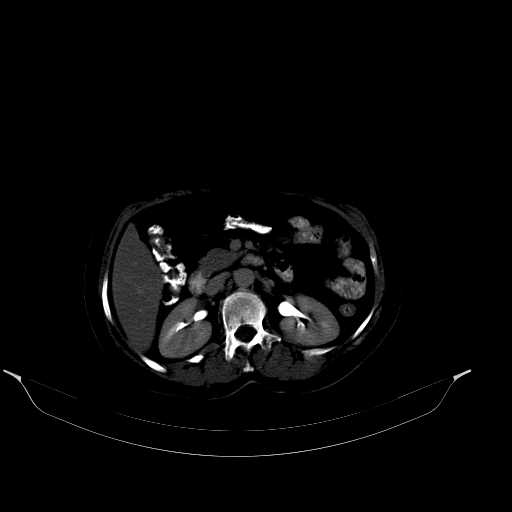 File:Calcified hydatid cyst of the liver (Radiopaedia 21212-21112 Axial bone window 22).jpg