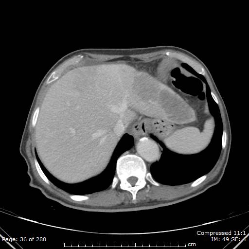 Calcified liver metastases (Radiopaedia 44699-48470 B 13).jpg