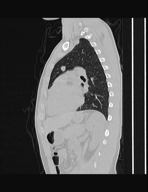Calcifying pulmonary metastases (Radiopaedia 33359-34396 Sagittal lung window 26).jpg