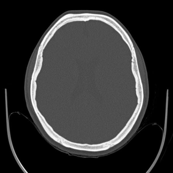 Calvarial osteoma (Radiopaedia 36520-38079 Axial bone window 65).jpg
