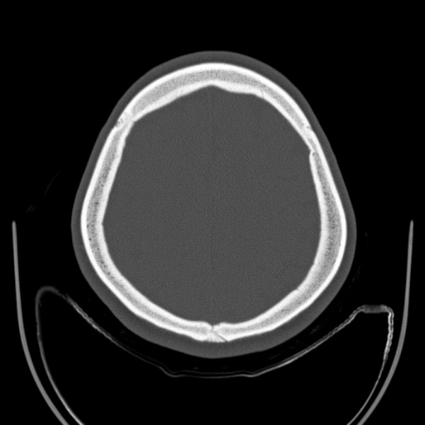 Calvarial osteoma (Radiopaedia 36520-38079 Axial bone window 85).jpg
