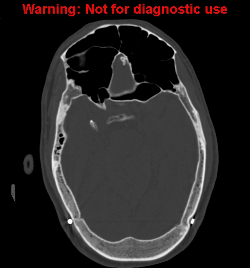 Calvarial thickening from chronic shunting (Radiopaedia 60079-67637 Axial bone window 73).jpg