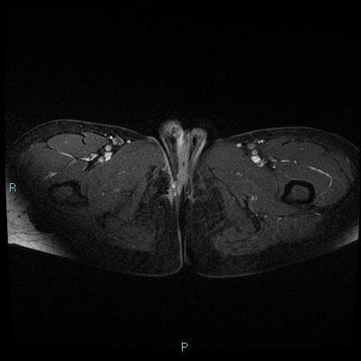 File:Canal of Nuck cyst (Radiopaedia 55074-61448 Axial T1 C+ fat sat 62).jpg