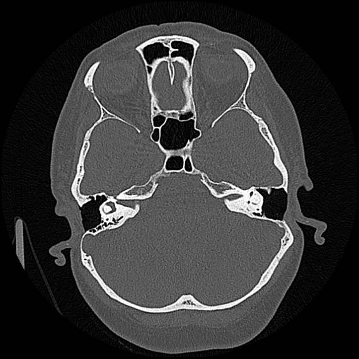 Canal up mastoidectomy (Radiopaedia 78108-90638 Axial bone window 86).jpg