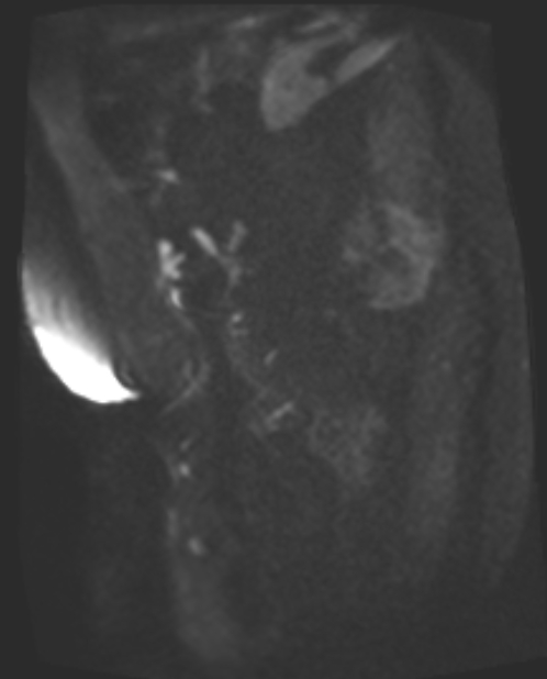 Cancer cervix - stage IIb (Radiopaedia 75411-86615 Sagittal DWI 71).jpg